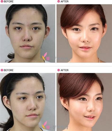 lv plastic surgery korea